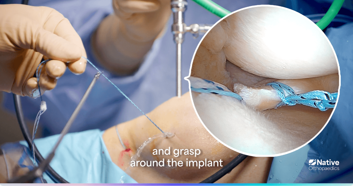 Surgical Technique | Native Orthopaedics